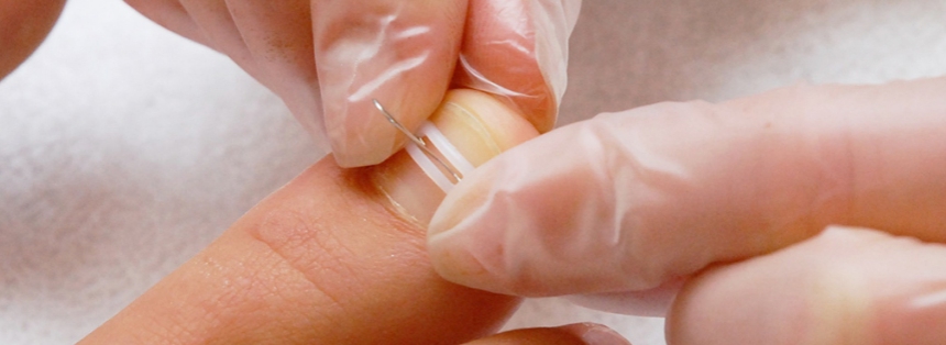 Лечение вросшего ногтя в Челябинске