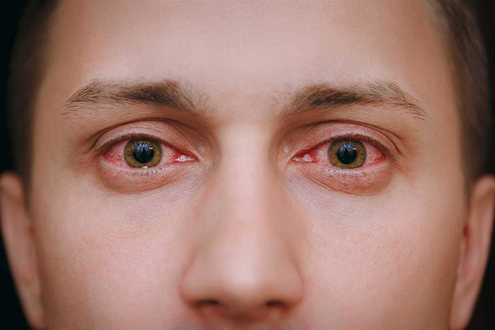 состояние глаз при sars-covid 19