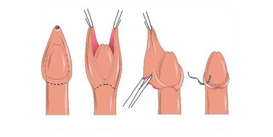 Все об обрезании крайней плоти у мужчин