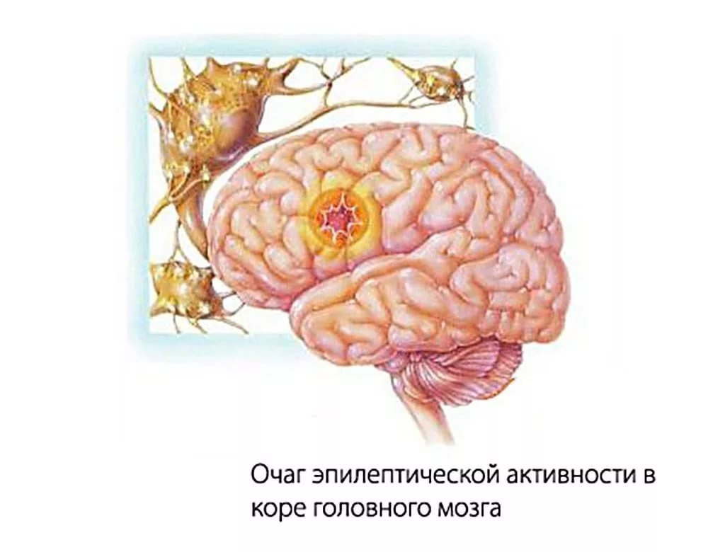 epileptolog1.jpg