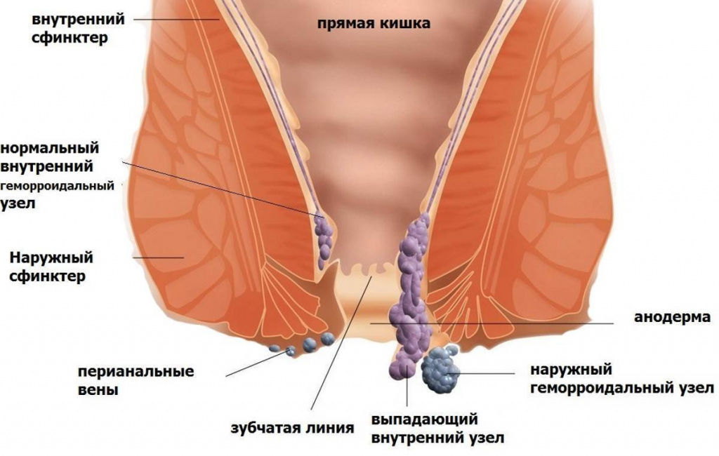 Лечение геморроя