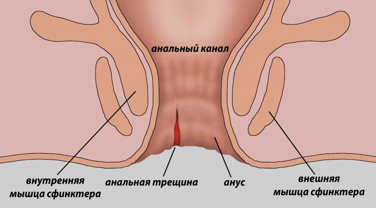 Анальная трещина