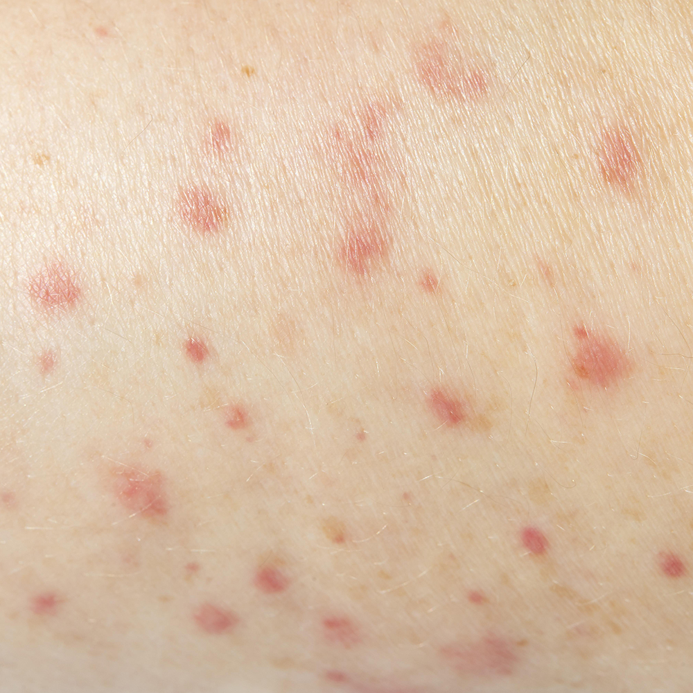 person-having-a-skin-allergy-close-up.jpg